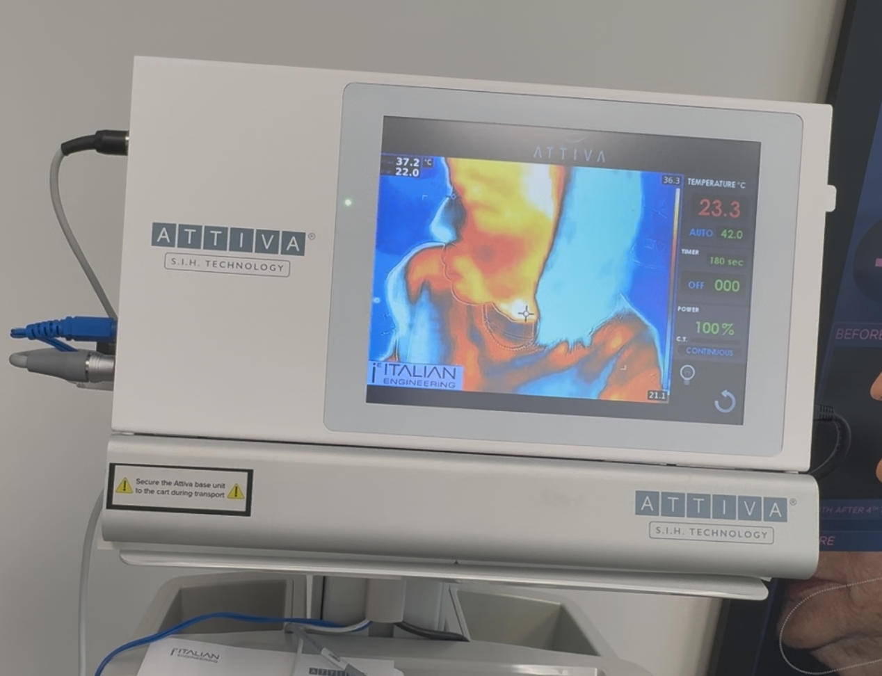 2024 Attiva RF For Sale - Under Skin RF + Warranty - Image 15
